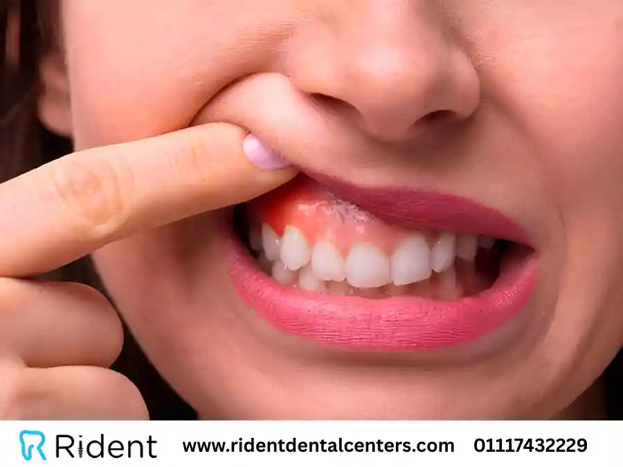 أنواع التهاب اللثة البسيط والشديد و8 طرق للعلاج